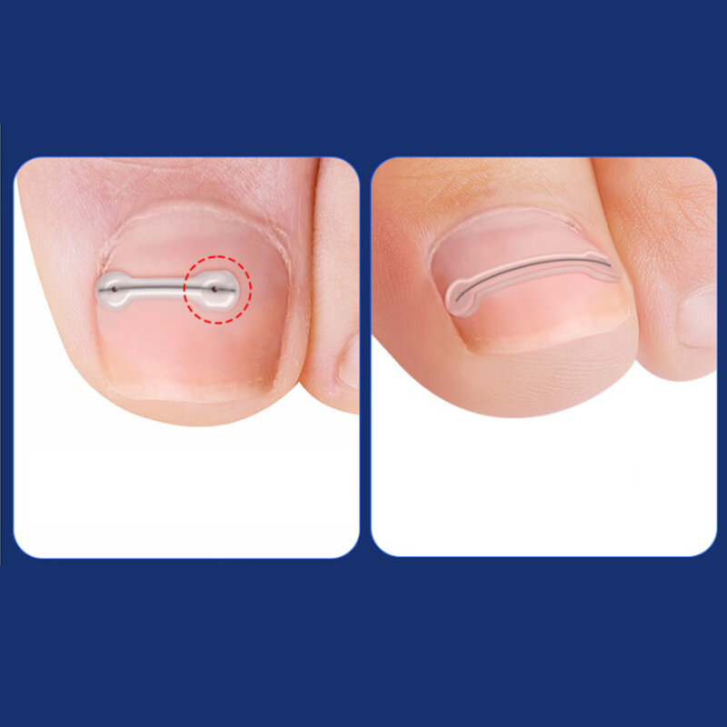 Strumenti per il correttore dell'unghia incarnita Pedicure recuperare il trattamento delle unghie dei piedi incorporati tutore per Clip lisciante per unghie incarnite professionale