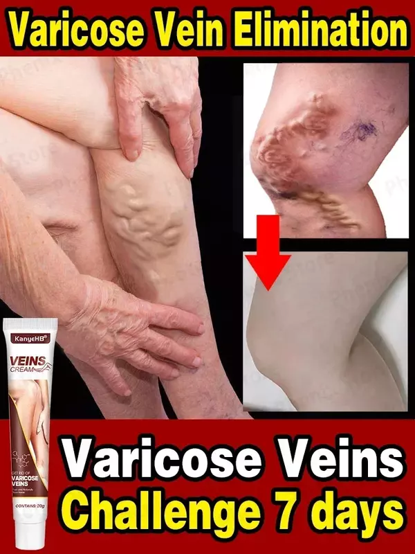 Effective Varicose Vein Relief Cream Eliminate Vasculitis Phlebitis Spider Legs Treatment Soothing Relieve Pain Herbal Ointment