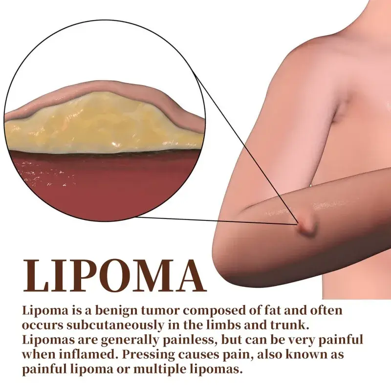 Lipoma ครีมรักษาใต้ผิวหนังเครื่องกำจัดก้อนไขมันใต้ผิวหนังของเหลวนำไปใช้กับเซลลูไลท์บวมไฟโบรโมพลาสเตอร์มวลไขมัน