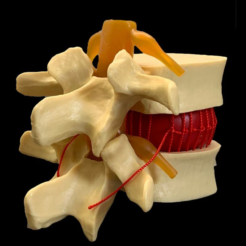 Modelo de demostración de hernia de disco Lumbar degenerativo, vértebras lumbares humanas anatómicas, modelo de columna vertebral humana, blanco, amarillo
