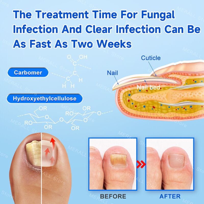 Pilz Nagel Laser Gerät Reparatur schnelle Nägel Pilz Onycho mykose Anti Thyreoiditis Linderung reines natürliches Öl Fußpflege Schönheit Gesundheit