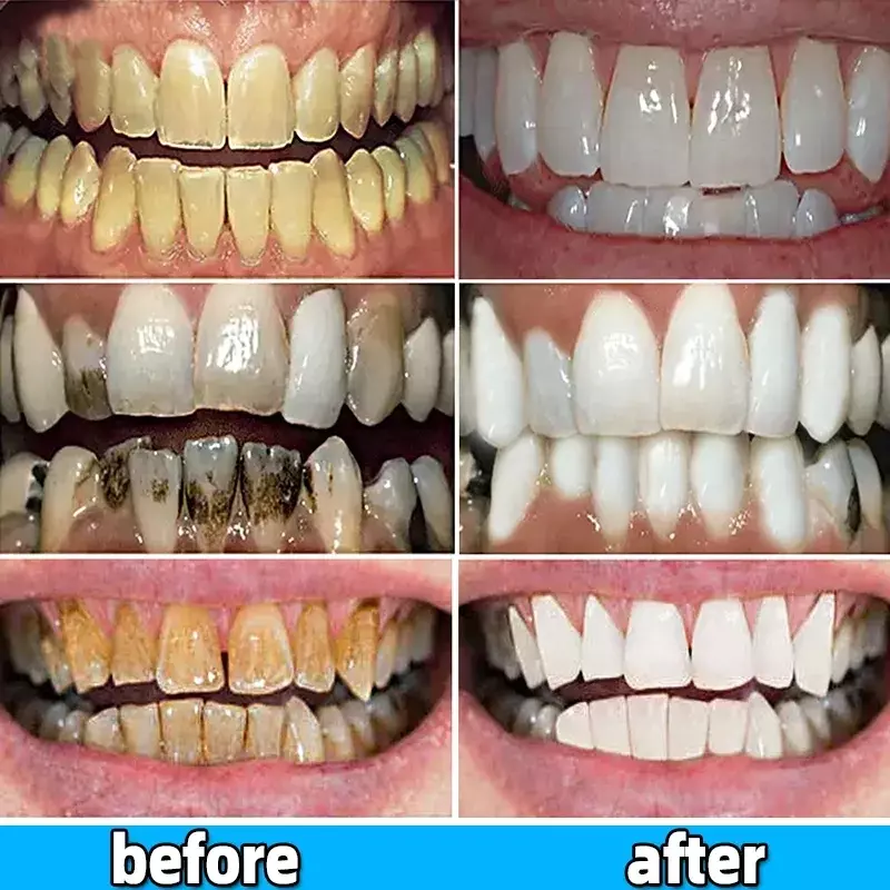 Средство для удаления зубного расчёса, отбеливания зубов
