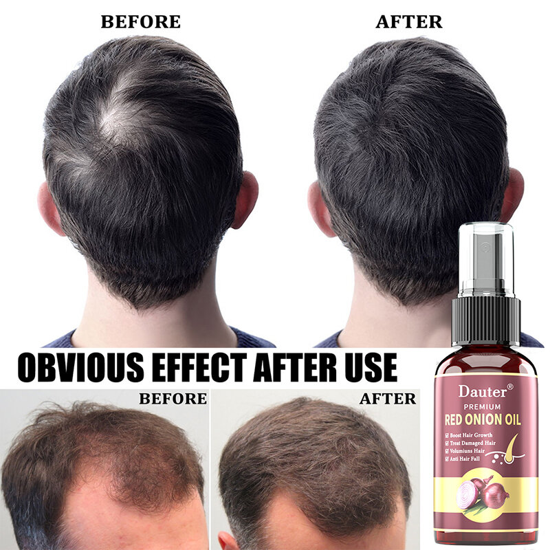 Spray natural anti perda de cabelo para homens e mulheres, óleo essencial, cuidado do crescimento do cabelo, tratamento do couro cabeludo, óleo
