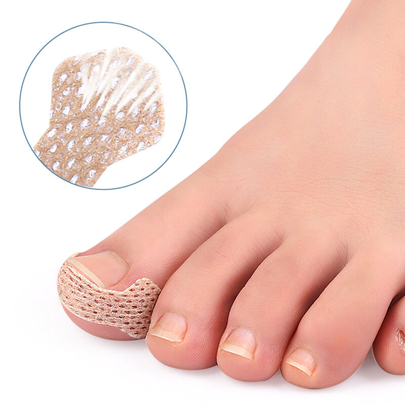 Toppe per unghie per il trattamento di paronichia con correttori per unghie e dispositivi di fissaggio per ripristinare la cura dei piedi dell'alluce