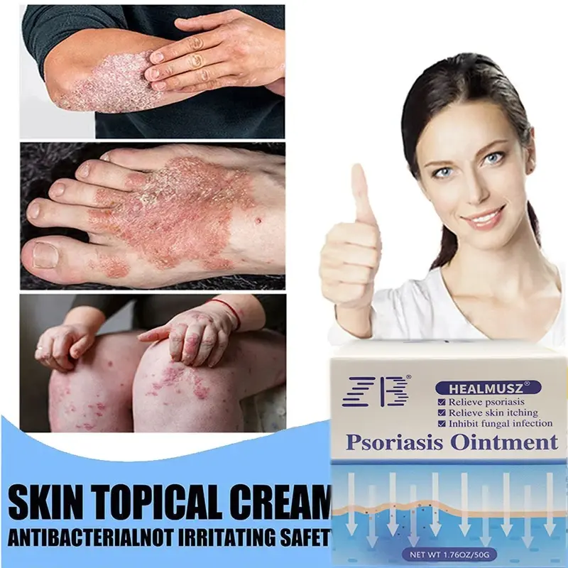 1pc Psoriasis Moisturizing Cream Natural Repair Effectively Antibacterial Relieve Exfoliate Dry Skin Itchy Rough Skin Care