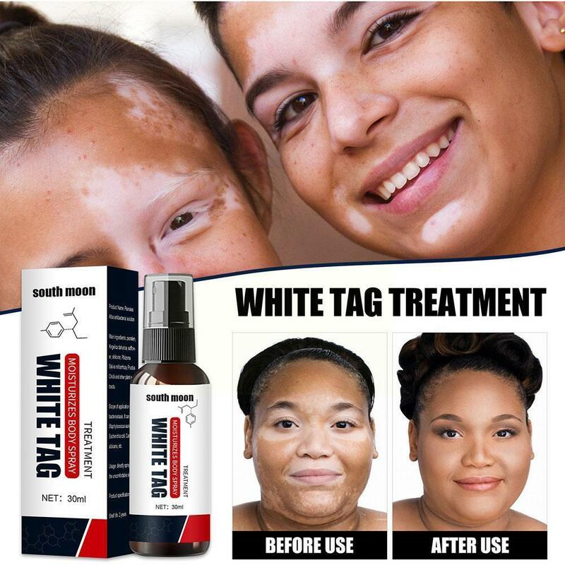 Novo branco removedor de manchas spray 30g antibacteriano erval vitiligo reparação da doença leukoplasia tratamento facial soro cuidados com o corpo