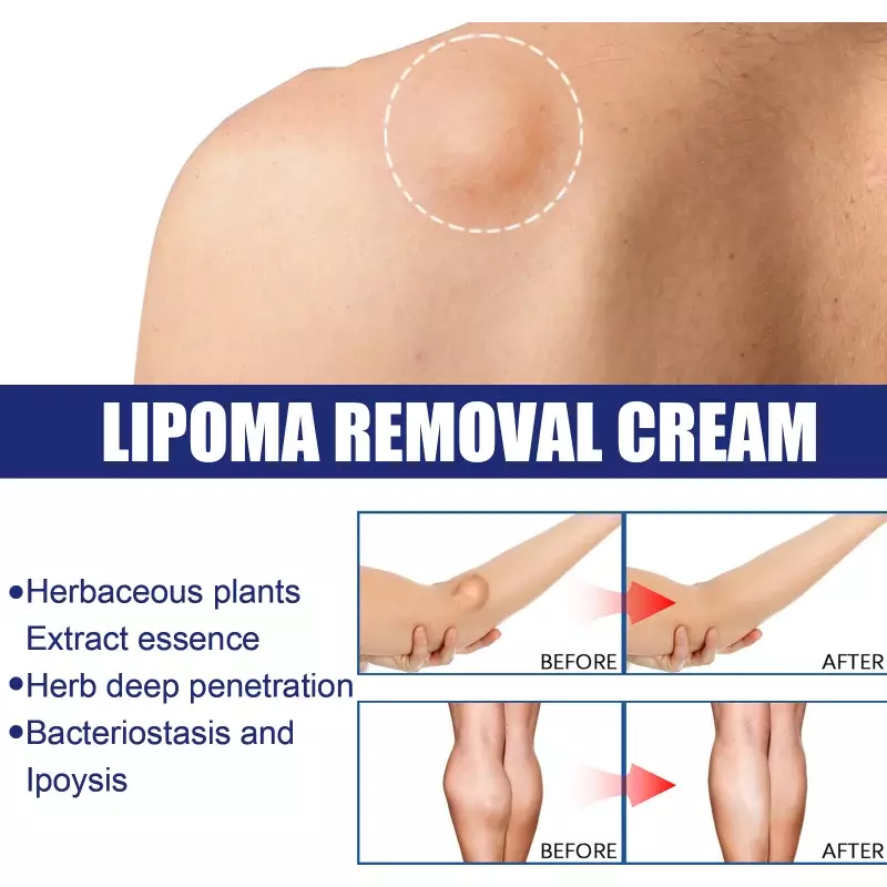 Lipoma Remover Treatment Cream Fat Mass Herbal Medicine Plaster Apply To Subcutaneous Lumps Fibroma Multiple Lipomas Cellulite