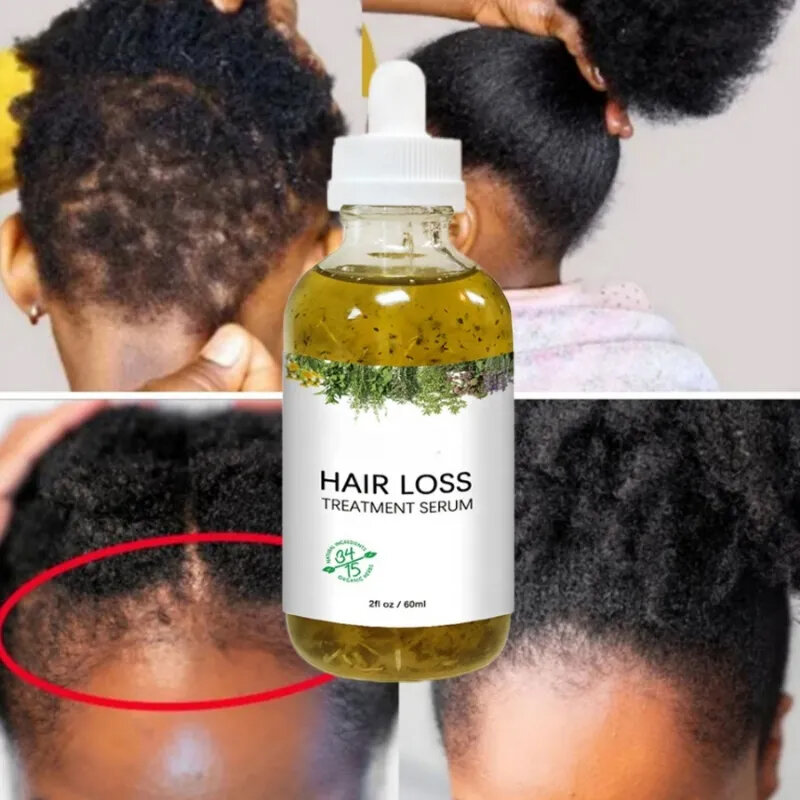 Productos de crecimiento del cabello de aceite para hombres y mujeres, Alopecia de tracción de crecimiento loco africano, prevención de la caída del cabello, crecimiento rápido, cuidado del cuero cabelludo