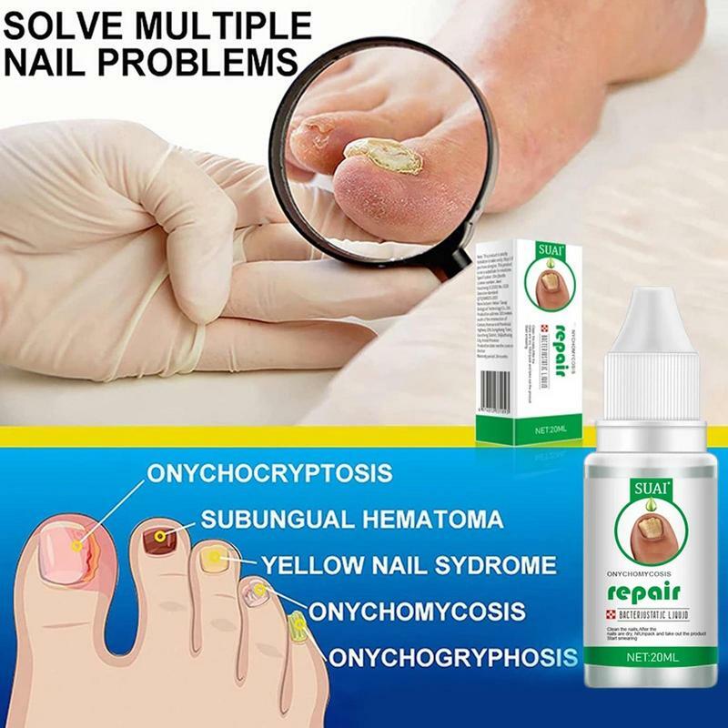 Rinforzatore per unghie dei piedi e Formula di crescita trattare ed eliminare le unghie rinnovare l'essenza soluzione per unghie chiarificante per unghie per unghie scolorite
