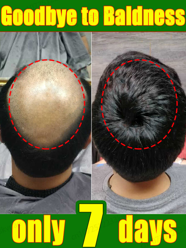 زيت أساسي لنمو الشعر ، زيت أساسي لنمو الشعر وعلاج الصلع وفقدان الشعر ، علاج فعال