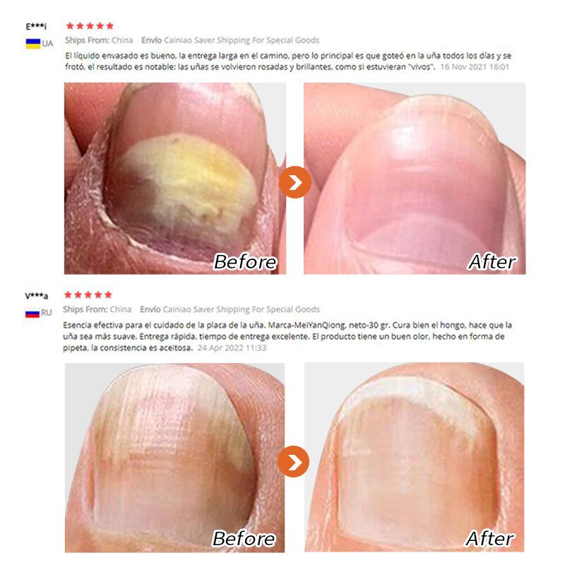 Terapia na paznokcie pielęgnacja stóp preparat do paznokci wybielanie stóp usuwanie grzybicy paznokci żel leczenie infekcji Paronychia Onychomycosis