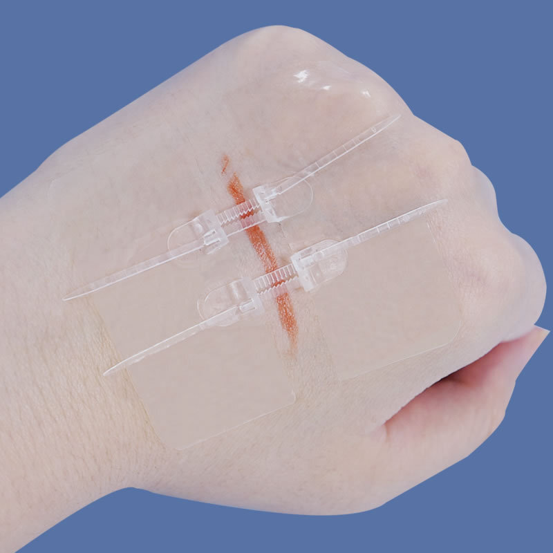 Zipper Tie Wound Encerramento Hemostatic Band-Aid, Sutura rápida, portátil, ao ar livre