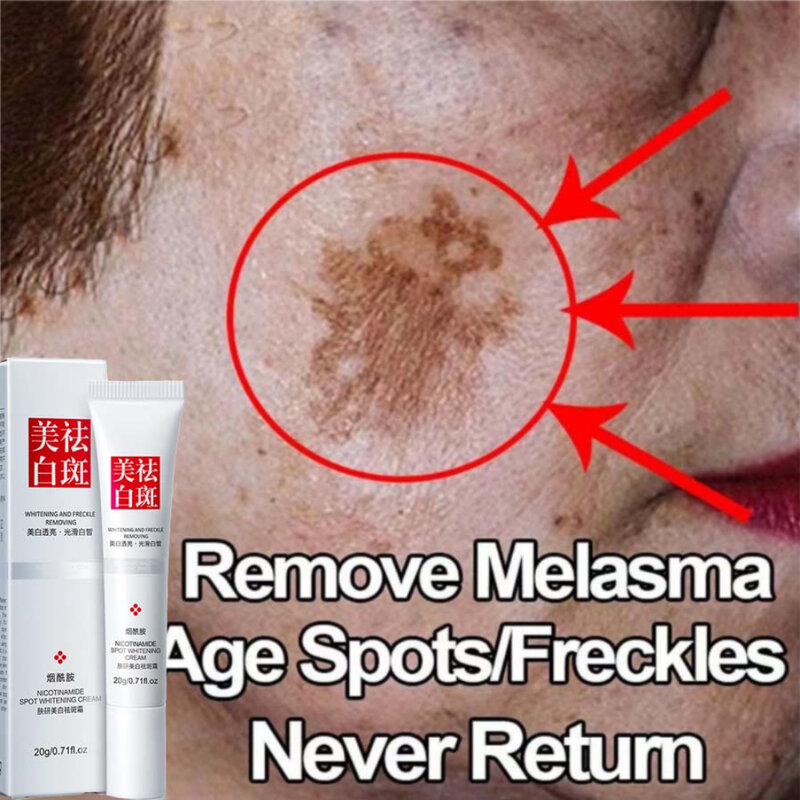 Effektive Weiß creme aufhellen Gesicht für Gesichts flecken entfernen dunkle Flecken Melasma Anti-Pigmentierung verbessern Mattheit Hautpflege creme