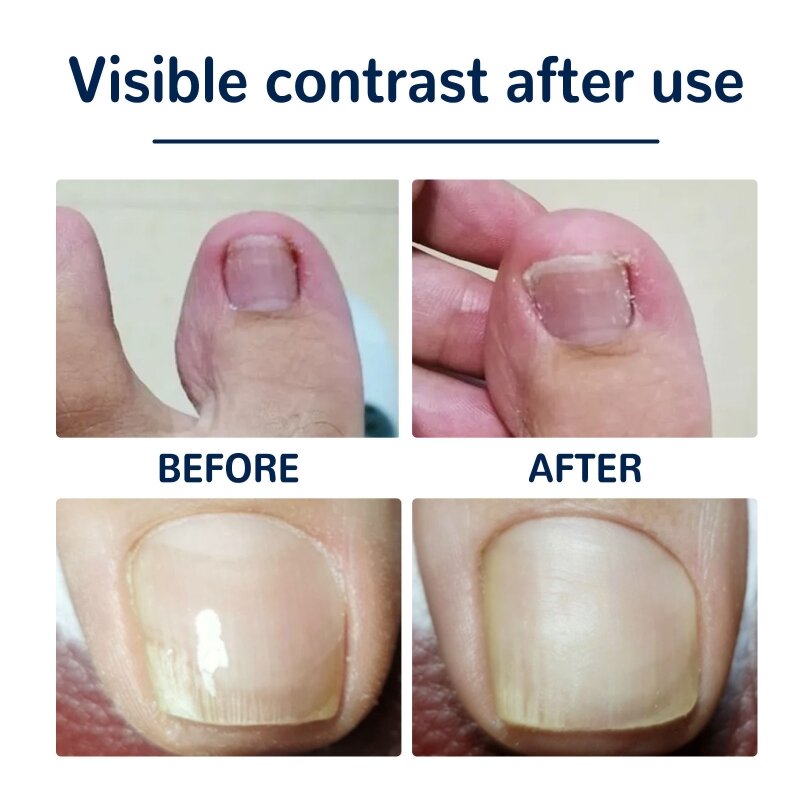 Ingrown Toenail Sticker Glue-free Toe Nail Correction Patch Paronychia Corrector