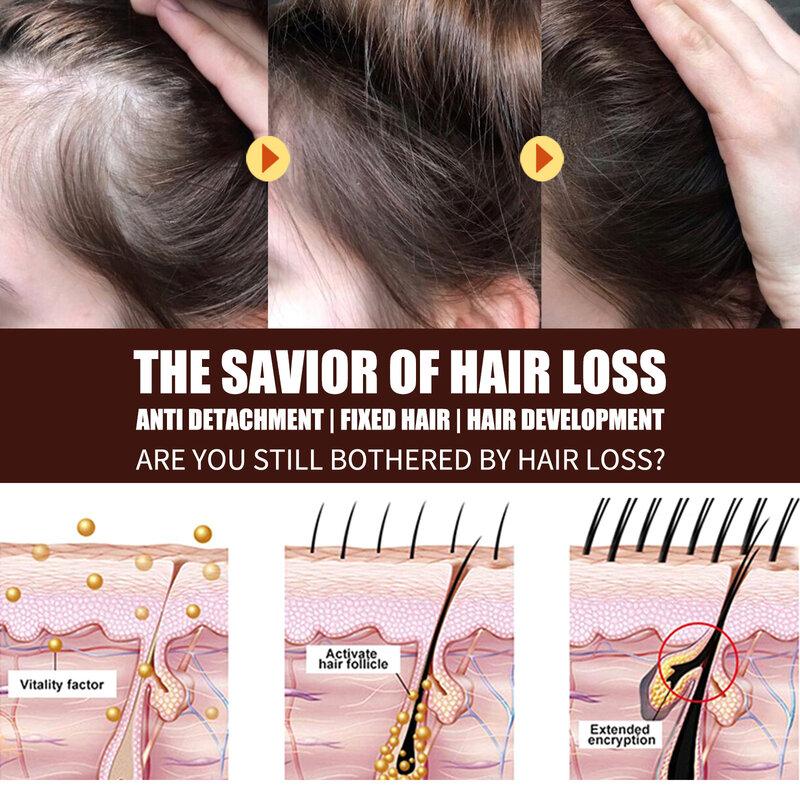 Aceite esencial para el crecimiento del cabello de romero, aceite para estimular los folículos, Anti calvicie, tratamiento efectivo del cuero cabelludo denso y aceitoso, adelgazamiento y engrosamiento