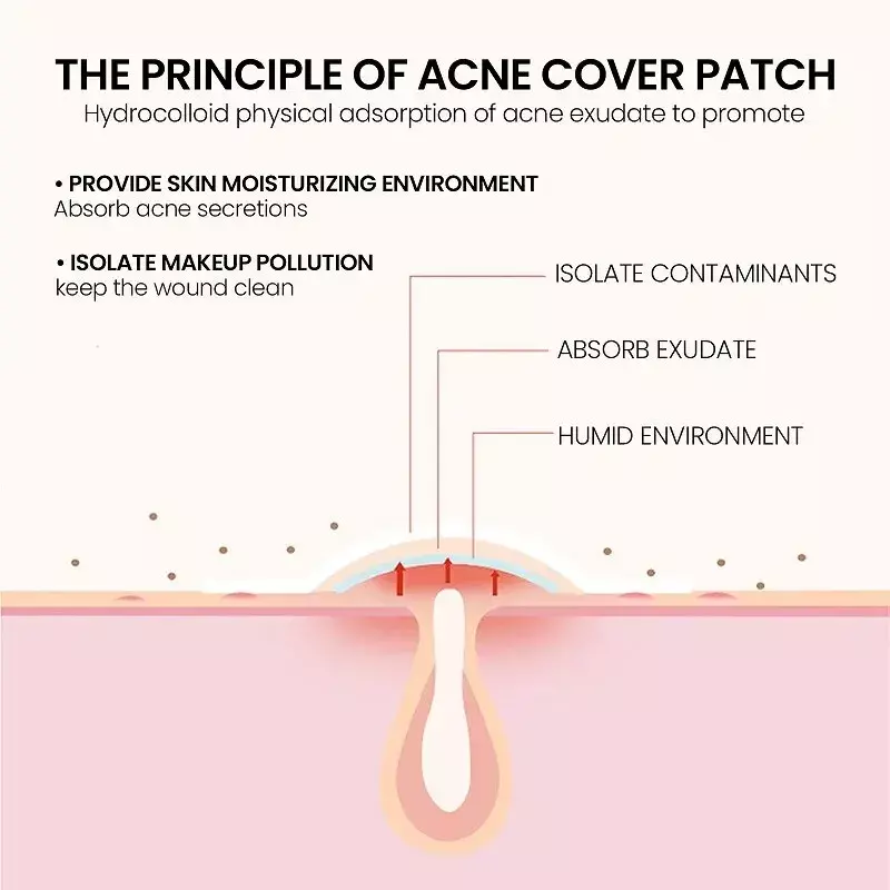 200pcs Repair Acne Patch Facial Skin Care Fade Blemishes Pimple Marks Closed Acne Blemishes Cover Acne Pimple Repair Patch
