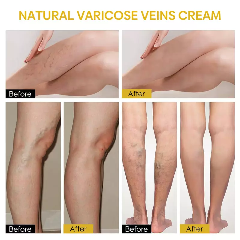 2pcs Venoheal Varicose Veins Ease Pain Paste, PasteSpider Veins, Cream for Legs, Skin, Improve Blood Circulation