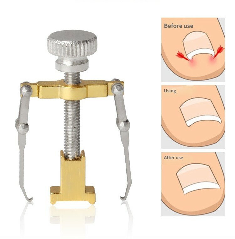 Clip lisciante correttore unghia incarnita Pedicure strumenti per la cura delle unghie dei piedi trattamento Pedicure in acciaio inossidabile correzione onice