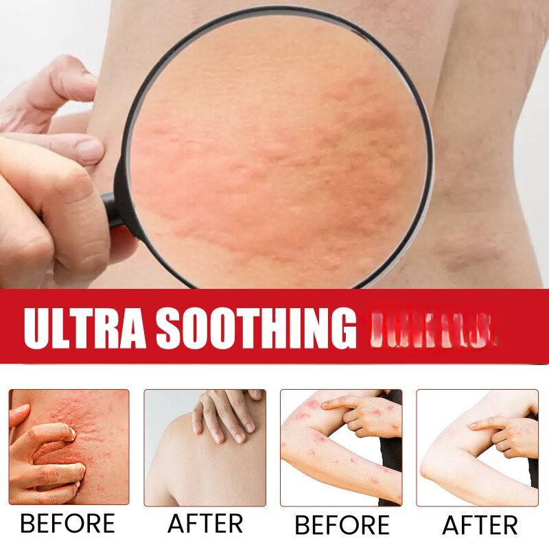 Haut Anti-Juckreiz-Creme lindern Mücken stiche stachelige Hitze rote juckende Haut Hände Füße dauerhafte juckende Körperpflege salbe