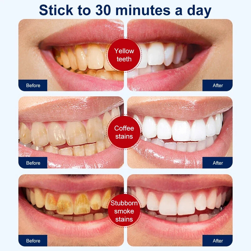 5D 치아 미백 스트립, 치아 미백 젤, 플라크 얼룩 제거, 차 커피 얼룩 표백 치과 도구, 밝은 흰색 치아 관리