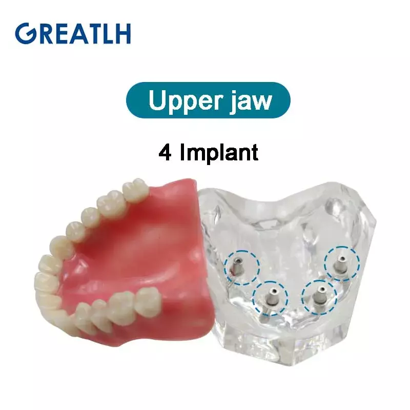 Dental Tanden Model Met Implant Overdenture Inferior Demo Onderkaak Model Tandarts Student Leren Model