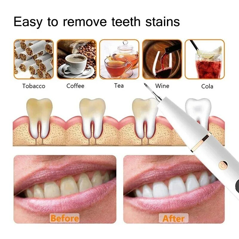 Portátil Elétrico Sonic Dental Cálculo Scaler, Removedor de tártaro de dentes orais, Limpador de manchas de placa