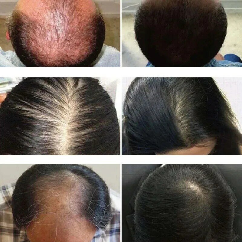 Spray na Serum wzrostu do włosów, który odbudowa włosów odżywiać odrastają korzenie, kuracja przeciw wypadaniu włosów esencja do pielęgnacji włosów dla mężczyzn kobiet