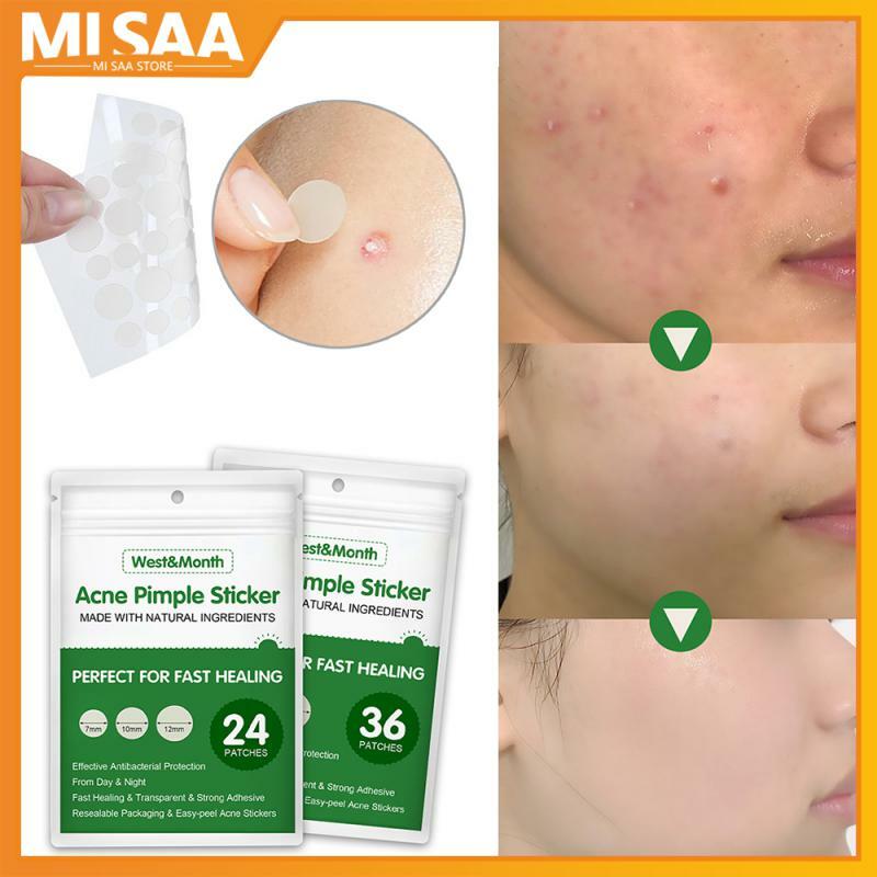 Parche impermeable para el acné, pegatina para el tratamiento del acné, removedor de espinillas, mascarilla Facial para el cuidado de la piel, accesorios de baño