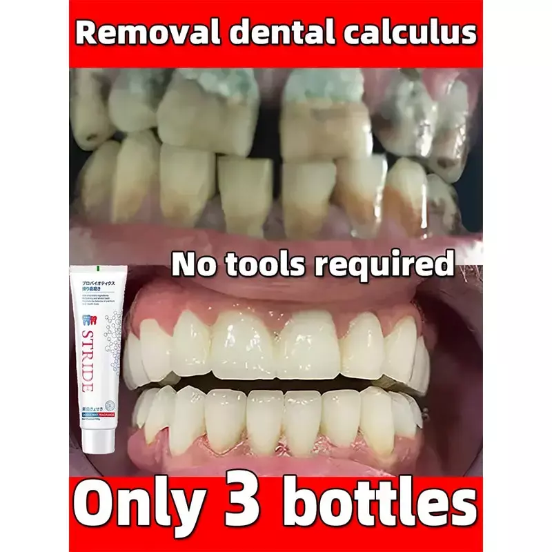 Removedor de cálculo Dental, pasta de dientes blanqueadora, eliminación de olores bucales, prevención del mal aliento, productos orales de Periodontitis