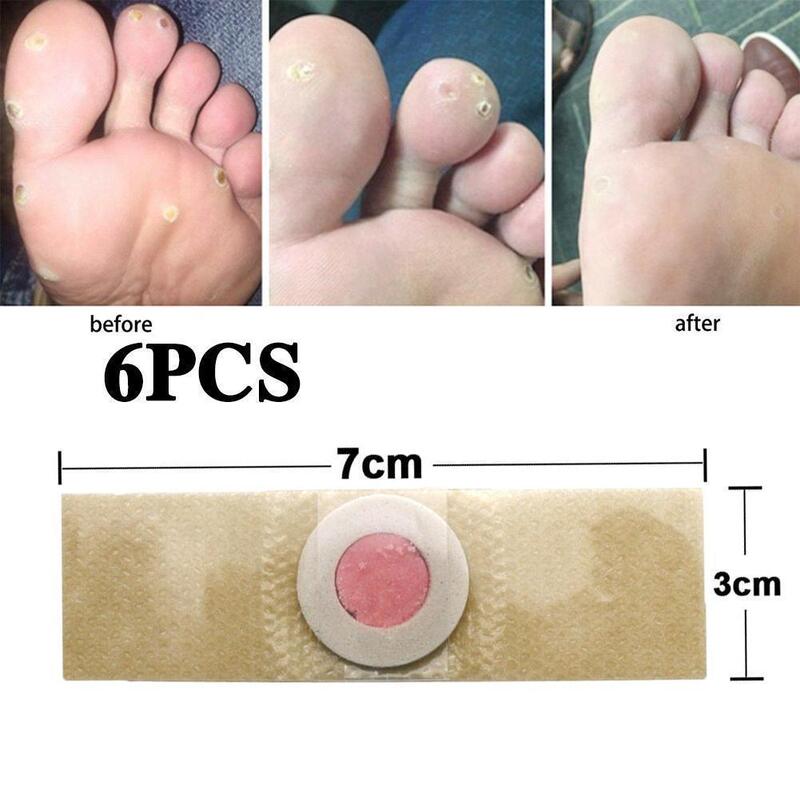 Patch adesivo de milho para remoção de calos, removedor de gesso, toe pads, almofada de calos, tecido não tecido, 6pcs