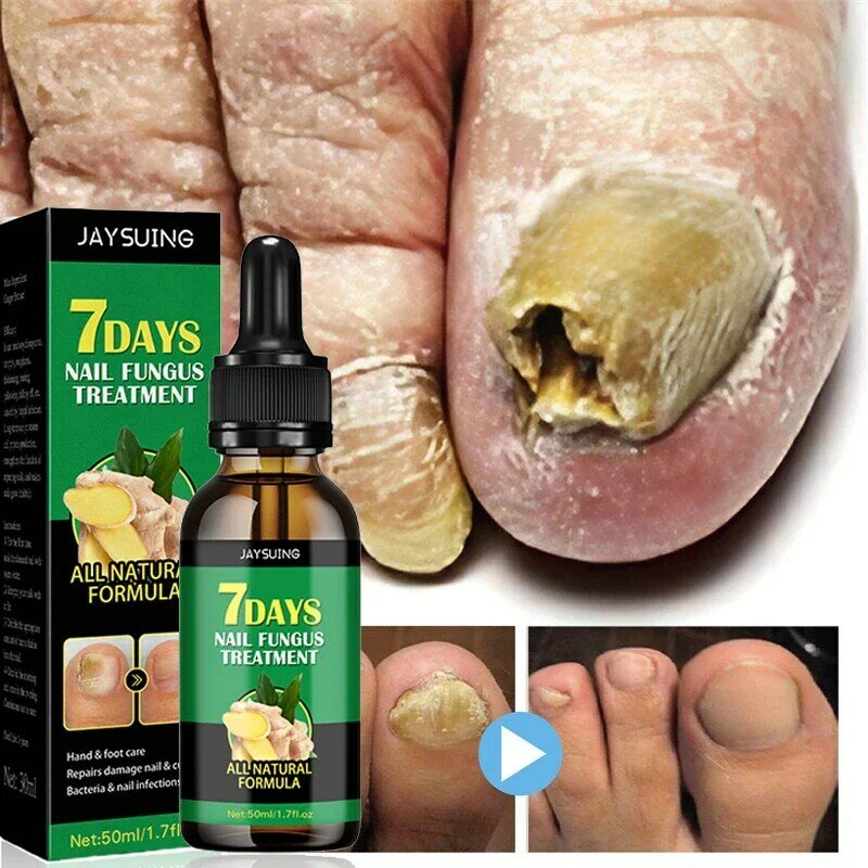 เซรั่มดูแลรักษาเชื้อราที่เล็บน้ำมัน Essential นิ้วเท้าเชื้อรานิ้วซ่อมแซม7วันผลิตภัณฑ์ดูแลป้องกันการติดเชื้อ