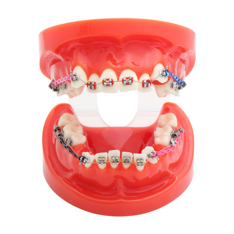 Trattamento ortodontico dentale modello di denti correzione della malocclusione con staffe metalliche modello didattico per la Demo del paziente