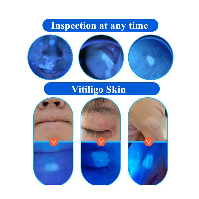Lamp Skin Analyzer UV Detection Wood's Lamp 16 LED UV Light Facial Skin Testing Machine For Vitiligo Skin Melasma  Pityriasis