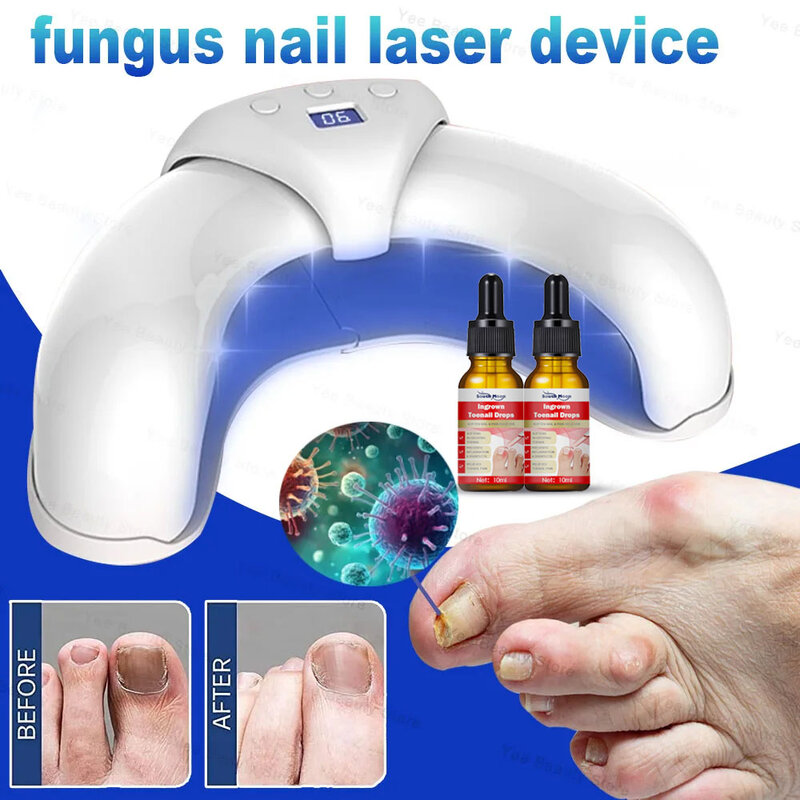 真菌-ネイルレーザーデバイス,迅速な爪の修理,指,カビ,爪真菌症,フットケア