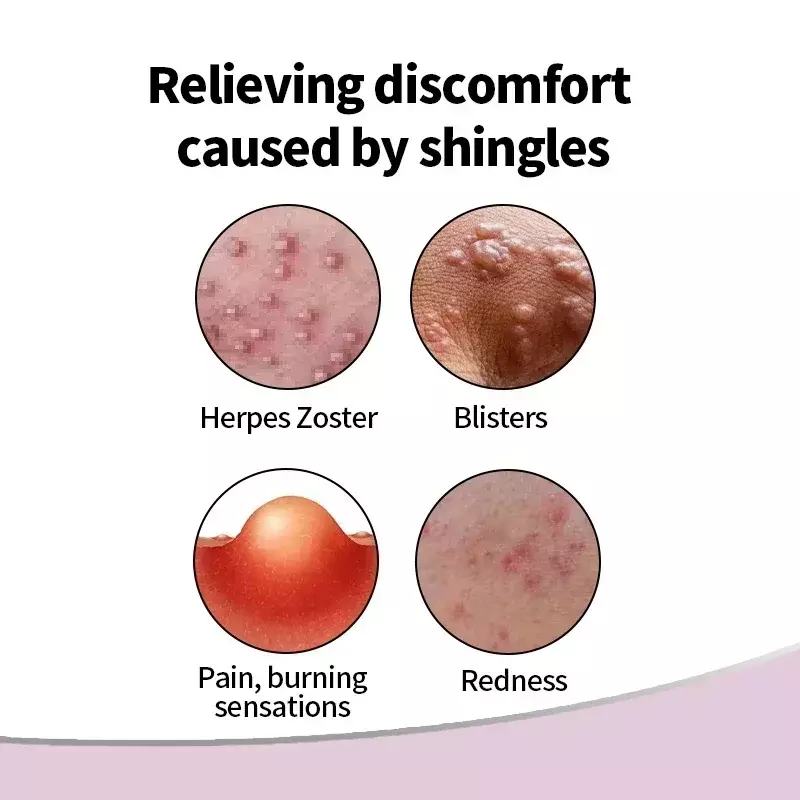 Herpes Zoster Behandeling Crème Gordelroos Genezen Huid Medicijn Slang Pijnlijke Rode Stip Blaar Herpes Simplex Thailand Zalf 50G