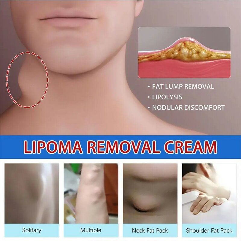 Lipoma Removal Cream Lipolysis Fat Lump Relief Plaster Skin Swelling Fat Elimination Cream Free Shipping 20g Health Care