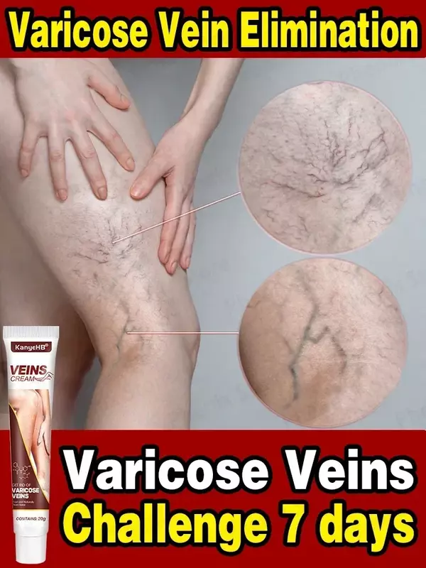 Efficace crema per il sollievo dalle vene Varicose elimina la vasculite flebite trattamento per le gambe del ragno lenitivo alleviare il dolore unguento a base di erbe
