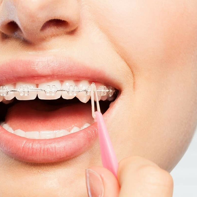 100 Stück Gummibänder für die Zahnpflege Zähne Gummibänder Zahnspangen Korrektur der Deformität 3,5 Unzen