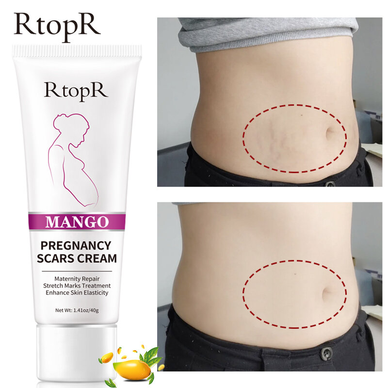 RtopR – Crème anti-vergetures de grossesse pour femmes enceintes, produit pour correction des pigments de la peau, gel corporel raffermissant et éclaircissant les marques, 40g,