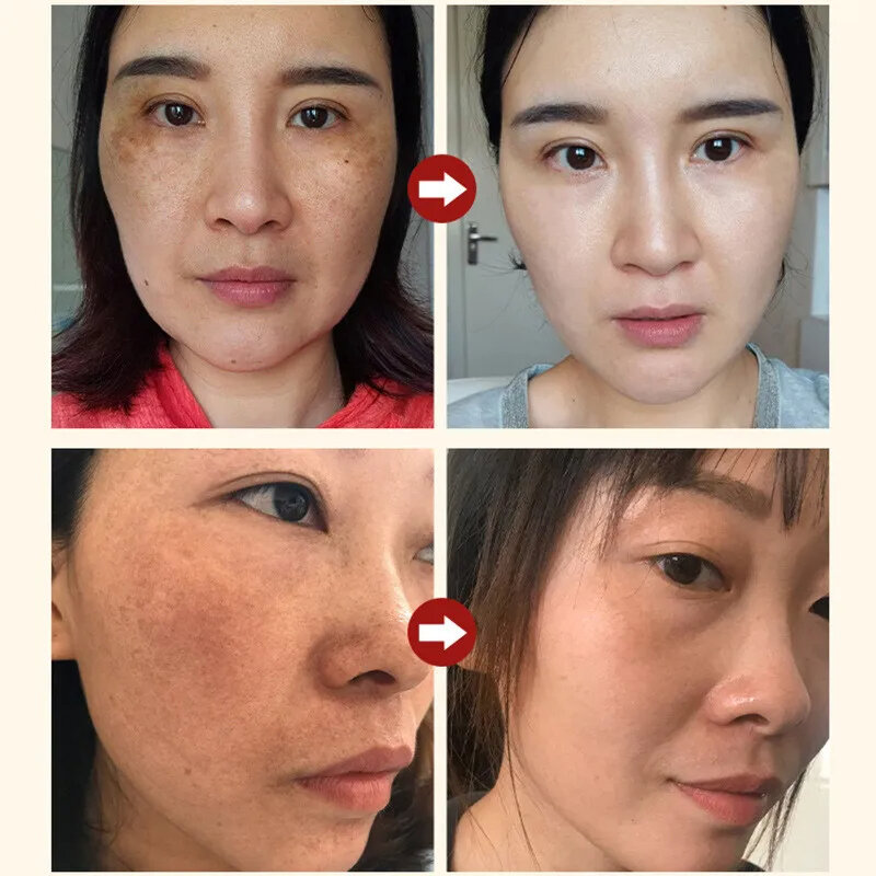 Whitening Freckles Cream Effective Remove Melasma Dark Spots Fade Pigmentation Moisturize Smooth Brighten Face Skin Care Product