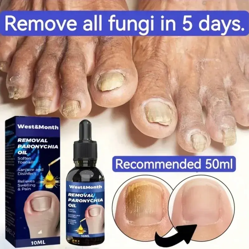 Tratamiento de paroniquia para uñas, alivio de recuperación, rejuvenecimiento de uñas, cuidado de los pies