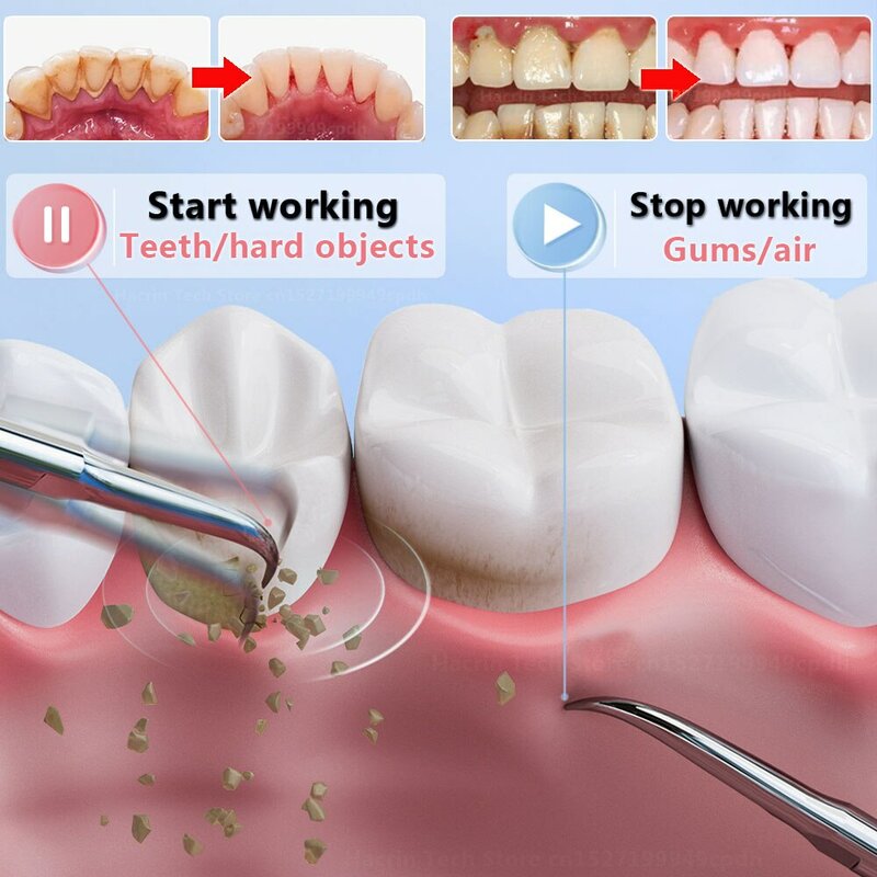 Tandheelkundige Scaler Ultrasone Scaler Tand Cleaner Tandsteen Verwijdering Elektrische Sonische Plak Remover Voor Tanden Vlek Tandsteen