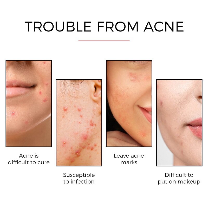 24pcs Face Acne Pimple Spot Scar Care Treatment Stickers Facial Skin Care Blackhead Removal Freckle Patches Acne Mask Beauty