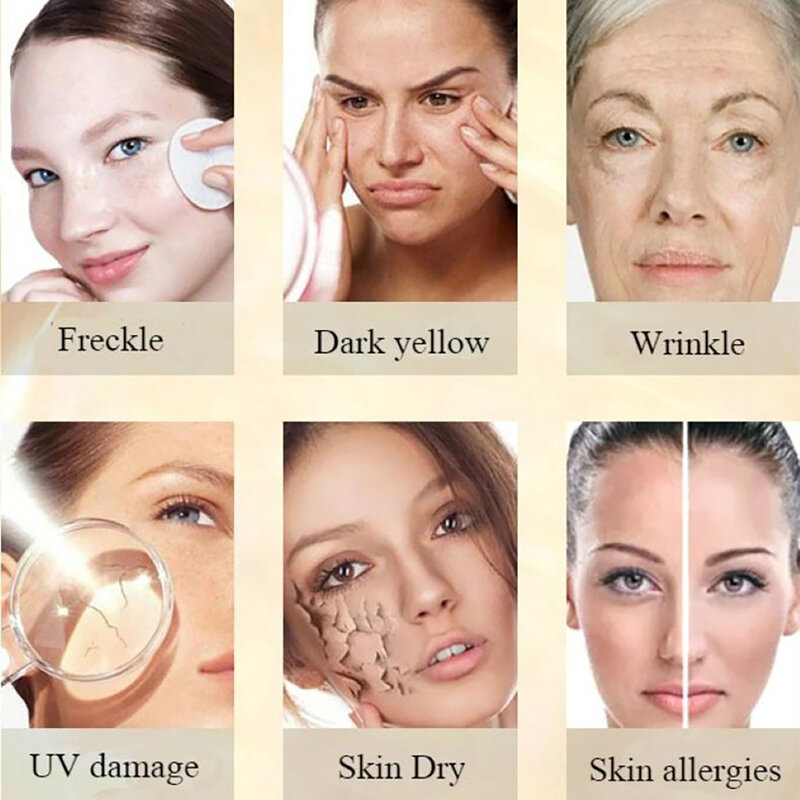 Efficace crema sbiancante rimuovi Melasma Acne Spot Pigment pigmentazione delle macchie scure cura della pelle