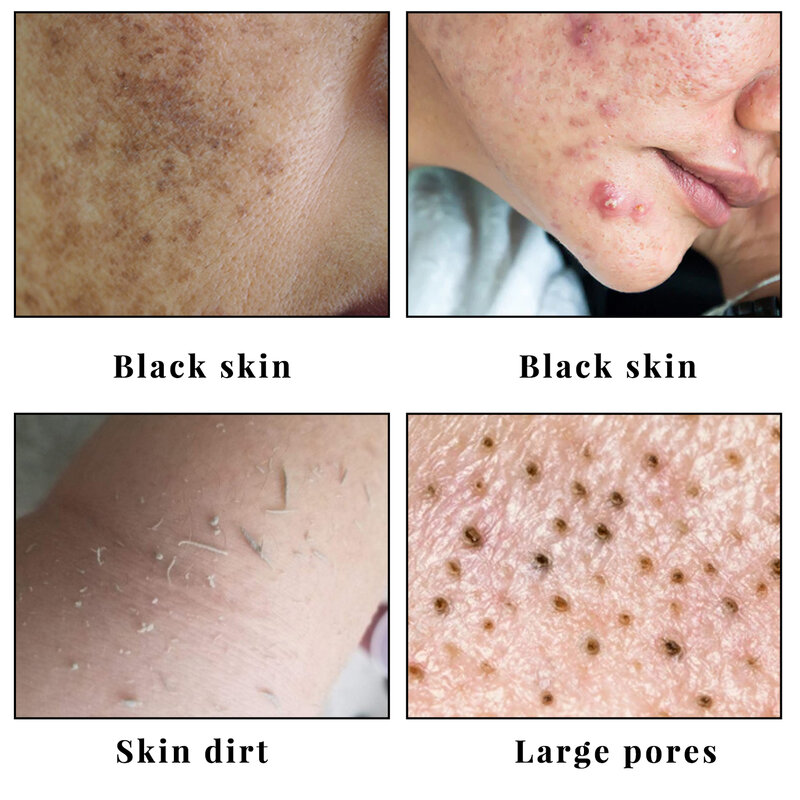 Kojic Acid Skin Care Set Facial Cleanser Body Lotion Handmade Soap Remove Dark Spots Whitening Anti Aging Remove Acne Body Care