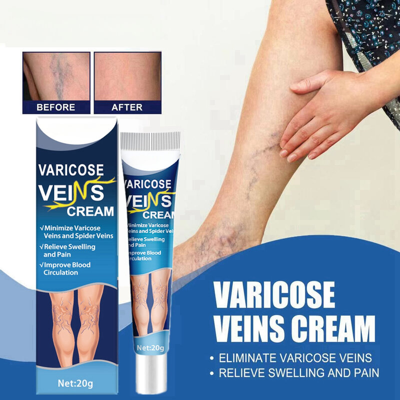 Varicoseクリームは20g、薬の除去のための医療軟膏を回避します。
