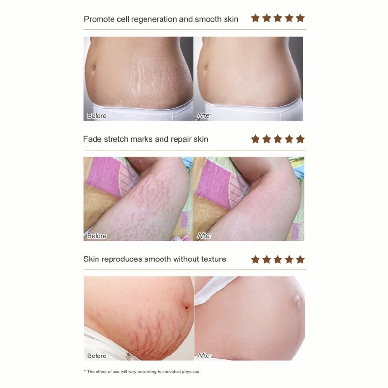 Crème d'élimination des cicatrices de grossesse femme enceinte Pigments Correction réparation corps raffermissant et les