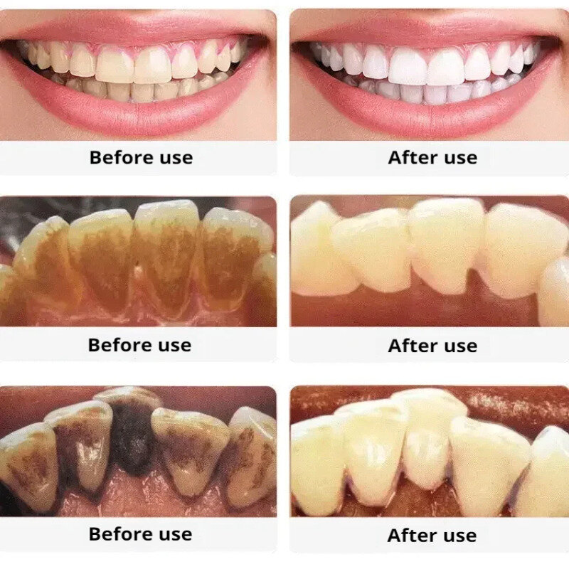 Scaler dental ultra-sônico sem fio, casa perseguindo frequência, Detartar Visual, limpeza frequência
