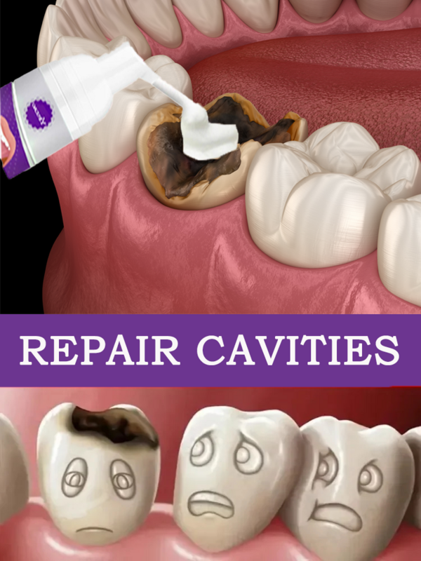 Perbaikan kerusakan gigi memperbaiki lubang melindungi Anti Caries