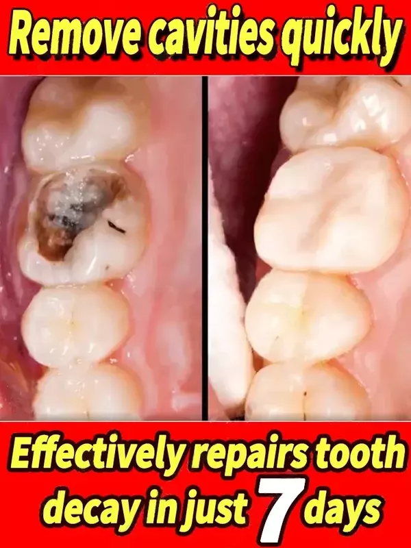 Dents filtrées pour éliminer temporairement la plaque dentaire, soulager les maux de dents